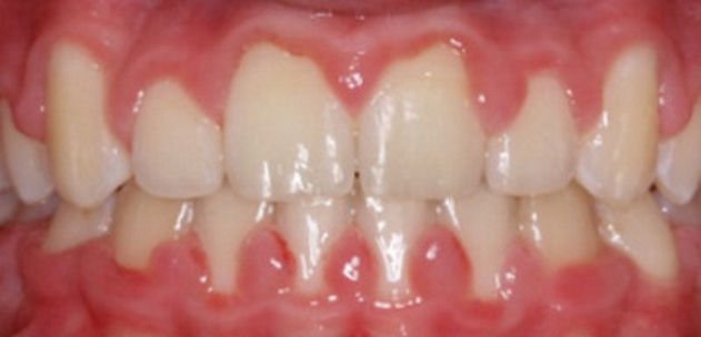 Gum Disease