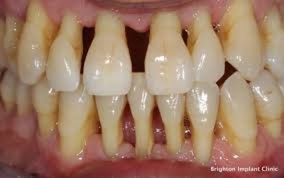Gum Disease
