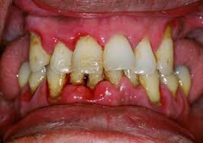 Gum Disease