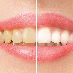Tooth Whitening