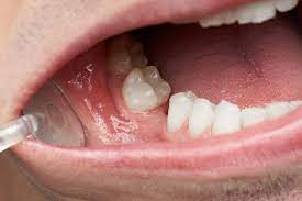 Missing Tooth