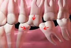 Missing Tooth
