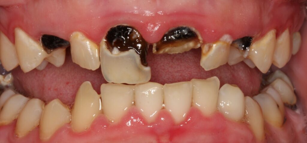 Tooth Decay