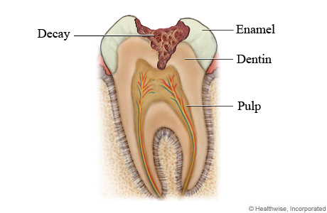 Tooth Decay