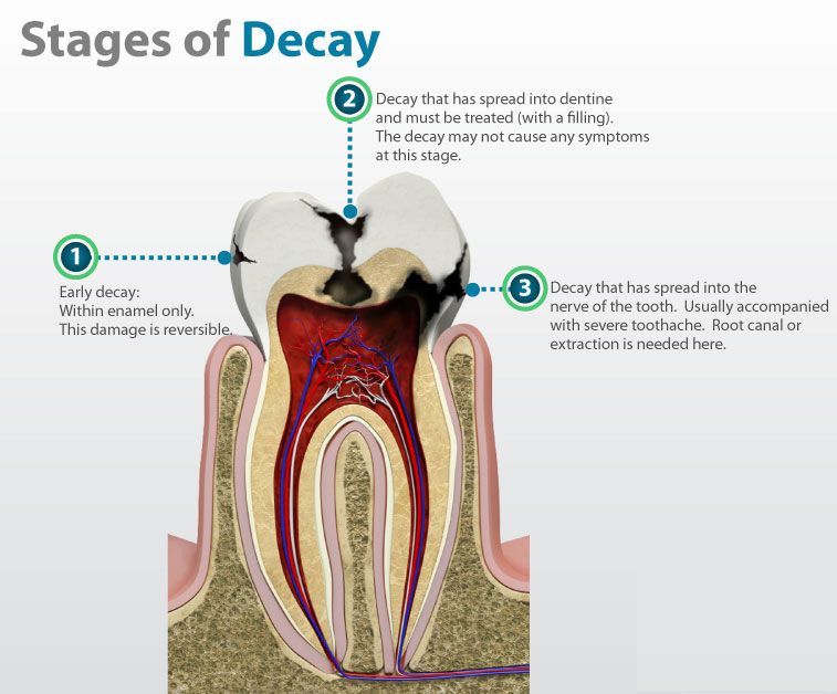 Stages of Tooth Decay
