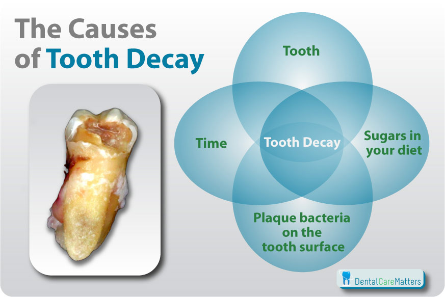 Causes of Tooth Decay