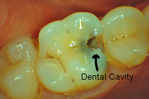 Tooth Decay
