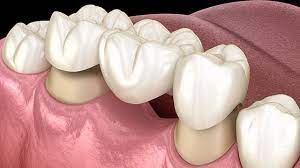 Dental Bridge