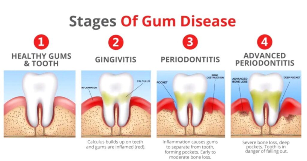 Gum Disease