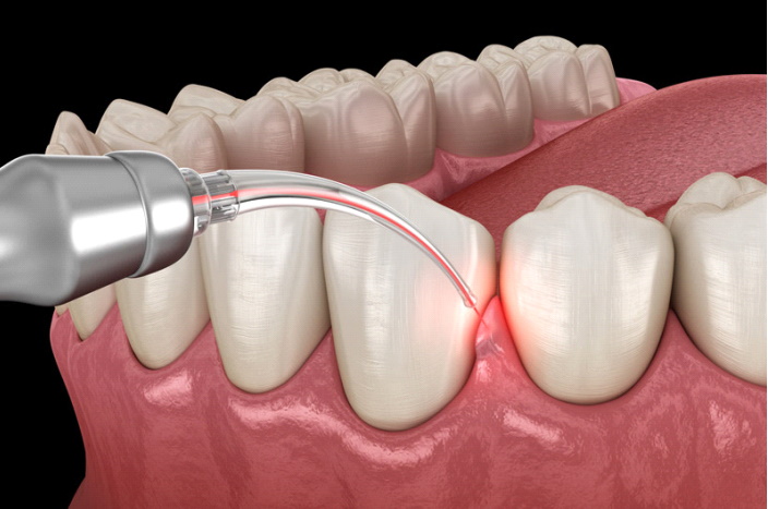 Laser treatment for Gum Disease