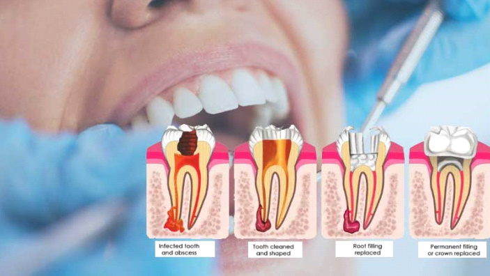 Laser Assisted Root Canal Treatment
