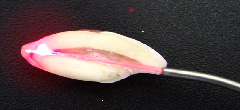 Laser Assisted Root Canal