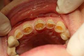Worn Out Teeth