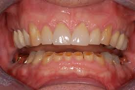 Worn Out Teeth