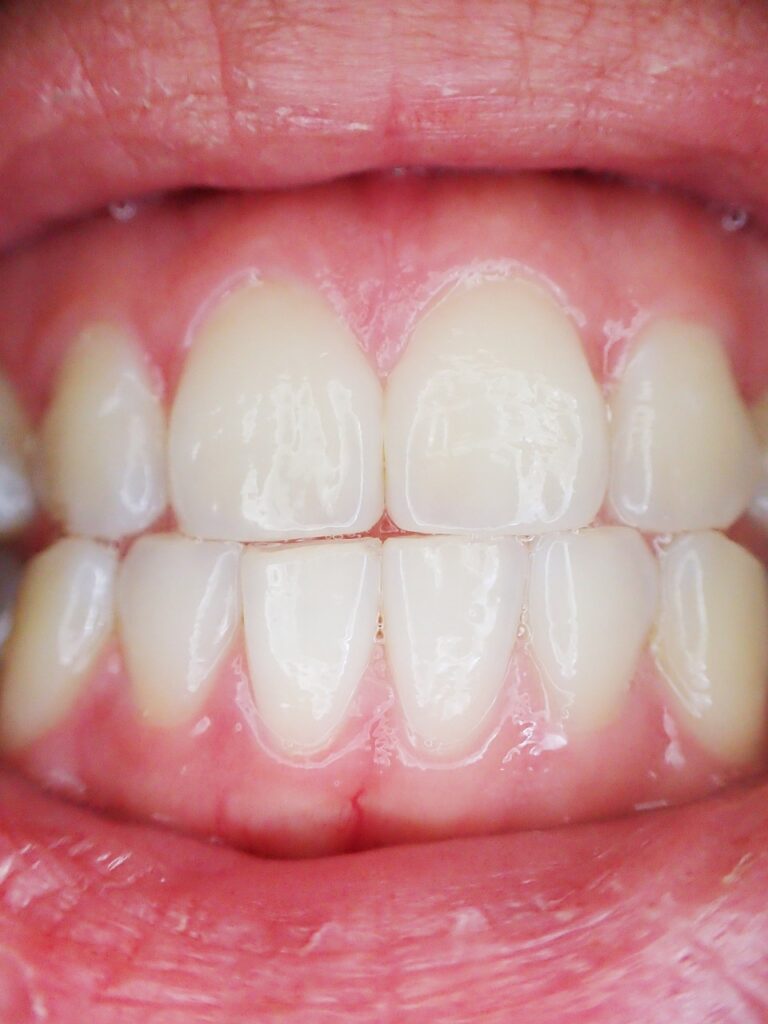 Gum Health