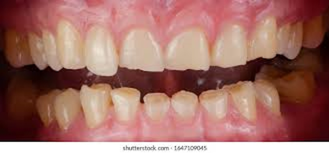 Bruxism
