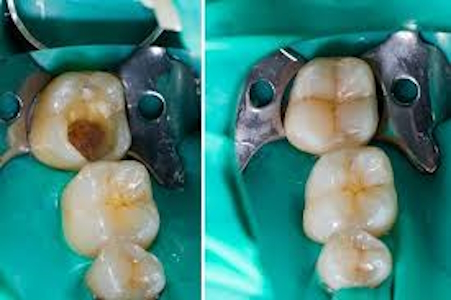 Dental Restorations