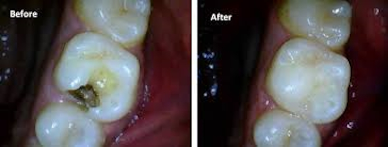 Dental Restorations