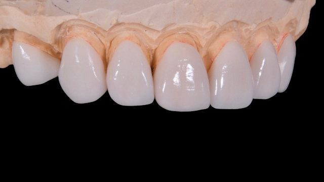 Veneers
