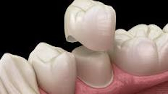Dental Crowns