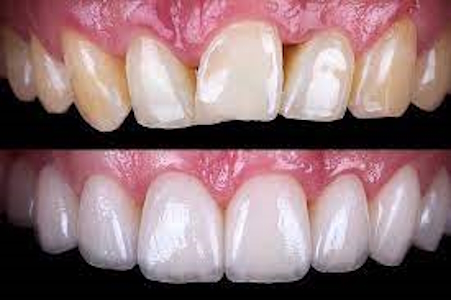 Dental Veneers
